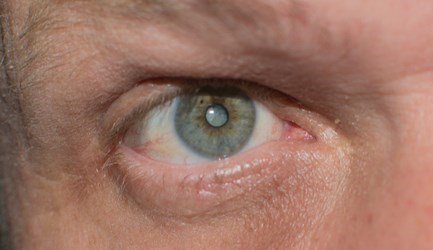 קטרקט - תמונת המחשה